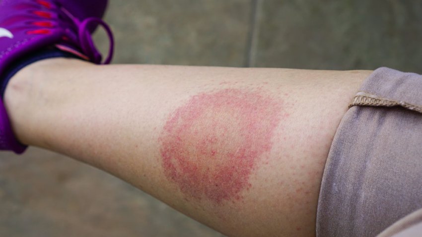 Tlmd-lyme-garrapata-888888