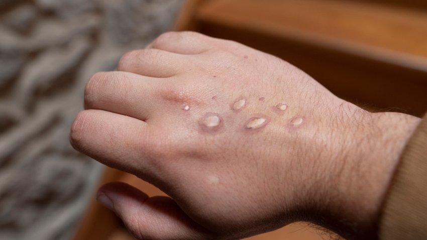 Monkey pox vesicles in a hand